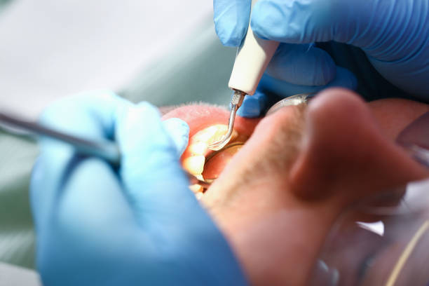 Best Emergency Wisdom Tooth Extraction in Woodland Park, CO